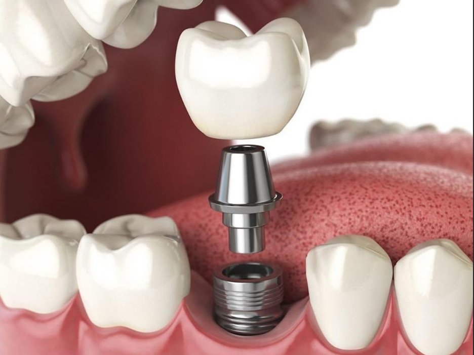 Не проходит онемение челюсти после имплантации зубов, как лечить парестезию